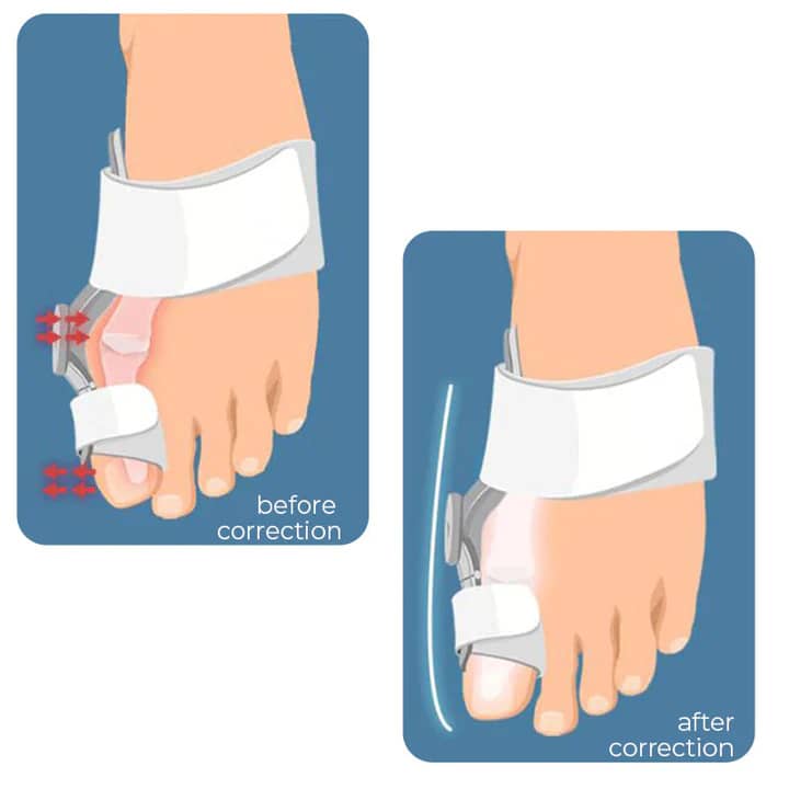 Bunion Corrector